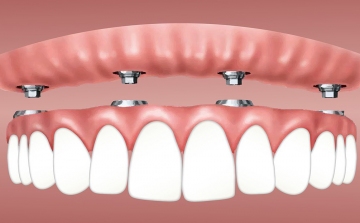 A fogászati implantátumokról röviden