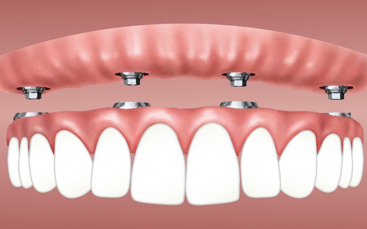 A fogászati implantátumokról röviden