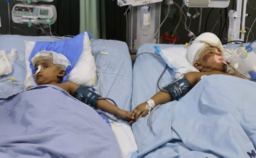 Szétválasztott sziámi ikrek - Rabeyán sürgős műtétet kellett végezni